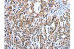 The image on the left is immunohistochemistry of paraffin-embedded Human esophagus cancer tissue using CSB-PA111567(EDN3 Antibody) at dilution 1/30, on the right is treated with fusion protein. (Original magnification: 