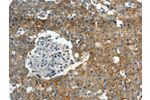 The image on the left is immunohistochemistry of paraffin-embedded Human breast cancer tissue using CSB-PA112004(ABCC10 Antibody) at dilution 1/30, on the right is treated with synthetic peptide. (Original magnification: 