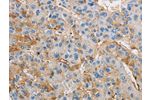 The image on the left is immunohistochemistry of paraffin-embedded Human liver cancer tissue using CSB-PA112219(DIRAS3 Antibody) at dilution 1/25, on the right is treated with fusion protein. (Original magnification: 