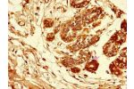 Immunohistochemistry of paraffin-embedded human breast cancer tissue using CSB-PA11339A0Rb at dilution of 1:100