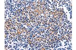The image on the left is immunohistochemistry of paraffin-embedded Human tonsil tissue using CSB-PA113726(CUL5 Antibody) at dilution 1/10, on the right is treated with fusion protein. (Original magnification: 