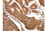The image on the left is immunohistochemistry of paraffin-embedded Human colon cancer tissue using CSB-PA113746(CCL17 Antibody) at dilution 1/70, on the right is treated with synthetic peptide. (Original magnification: 