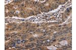 The image on the left is immunohistochemistry of paraffin-embedded Human colon cancer tissue using CSB-PA114148(EIF3H Antibody) at dilution 1/40, on the right is treated with fusion protein. (Original magnification: 
