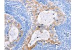 The image on the left is immunohistochemistry of paraffin-embedded Human cervical cancer tissue using CSB-PA114305(CFLAR Antibody) at dilution 1/15, on the right is treated with fusion protein. (Original magnification: 