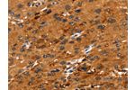 The image on the left is immunohistochemistry of paraffin-embedded Human liver cancer tissue using CSB-PA114336(FGFR3 Antibody) at dilution 1/30, on the right is treated with synthetic peptide. (Original magnification: 