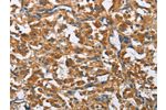 The image on the left is immunohistochemistry of paraffin-embedded Human thyroid cancer tissue using CSB-PA114413(COPB1 Antibody) at dilution 1/50, on the right is treated with fusion protein. (Original magnification: 