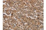The image on the left is immunohistochemistry of paraffin-embedded Human liver cancer tissue using CSB-PA114463(ACHE Antibody) at dilution 1/20, on the right is treated with synthetic peptide. (Original magnification: 