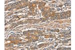 The image on the left is immunohistochemistry of paraffin-embedded Human gastic cancer tissue using CSB-PA114714(CUEDC2 Antibody) at dilution 1/30, on the right is treated with fusion protein. (Original magnification: 