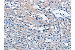 The image on the left is immunohistochemistry of paraffin-embedded Human thyroid cancer tissue using CSB-PA114726(BTN2A2 Antibody) at dilution 1/40, on the right is treated with fusion protein. (Original magnification: 