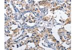 The image on the left is immunohistochemistry of paraffin-embedded Human thyroid cancer tissue using CSB-PA114834(CLEC2D Antibody) at dilution 1/60, on the right is treated with fusion protein. (Original magnification: 
