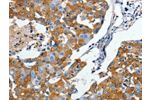 The image on the left is immunohistochemistry of paraffin-embedded Human breast cancer tissue using CSB-PA114925(DPYSL5 Antibody) at dilution 1/10, on the right is treated with synthetic peptide. (Original magnification: 