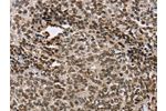 The image on the left is immunohistochemistry of paraffin-embedded Human ovarian cancer tissue using CSB-PA114928(ACVR1B Antibody) at dilution 1/25, on the right is treated with fusion protein. (Original magnification: 