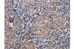 The image on the left is immunohistochemistry of paraffin-embedded Human thyroid cancer tissue using CSB-PA114938(CDC16 Antibody) at dilution 1/50, on the right is treated with synthetic peptide. (Original magnification: 