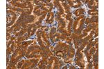 The image on the left is immunohistochemistry of paraffin-embedded Human thyroid cancer tissue using CSB-PA115010(CTSC Antibody) at dilution 1/50, on the right is treated with synthetic peptide. (Original magnification: 