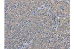 The image on the left is immunohistochemistry of paraffin-embedded Human thyroid cancer tissue using CSB-PA115608(EZR Antibody) at dilution 1/30, on the right is treated with fusion protein. (Original magnification: 