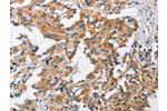 The image on the left is immunohistochemistry of paraffin-embedded Human thyroid cancer tissue using CSB-PA116460(CHMP1A Antibody) at dilution 1/60, on the right is treated with fusion protein. (Original magnification: 