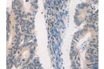 The image on the left is immunohistochemistry of paraffin-embedded Human colon cancer tissue using CSB-PA116677(NFE2L2 Antibody) at dilution 1/15, on the right is treated with fusion protein. (Original magnification: 
