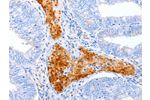 The image on the left is immunohistochemistry of paraffin-embedded Human cervical cancer tissue using CSB-PA117174(ENPP7 Antibody) at dilution 1/50, on the right is treated with synthetic peptide. (Original magnification: 