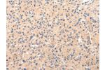 The image on the left is immunohistochemistry of paraffin-embedded Human liver cancer tissue using CSB-PA117475(CLU Antibody) at dilution 1/20, on the right is treated with synthetic peptide. (Original magnification: 