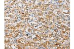 The image on the left is immunohistochemistry of paraffin-embedded Human thyroid cancer tissue using CSB-PA117483(APOBEC3G Antibody) at dilution 1/30, on the right is treated with fusion protein. (Original magnification: 
