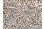The image on the left is immunohistochemistry of paraffin-embedded Human liver cancer tissue using CSB-PA117703(ANGPT1 Antibody) at dilution 1/30, on the right is treated with fusion protein. (Original magnification: 