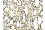 The image on the left is immunohistochemistry of paraffin-embedded Human thyroid cancer tissue using CSB-PA118672(CCL25 Antibody) at dilution 1/20, on the right is treated with fusion protein. (Original magnification: 