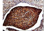 The image is immunohistochemistry of paraffin-embedded Human cervical cancer tissue using CSB-PA118689(ANXA7 Antibody) at dilution 1/150. (Original magnification: 