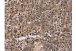The image on the left is immunohistochemistry of paraffin-embedded Human liver cancer tissue using CSB-PA118886(FAM107A Antibody) at dilution 1/30, on the right is treated with fusion protein. (Original magnification: 
