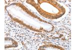 The image on the left is immunohistochemistry of paraffin-embedded Human colon cancer tissue using CSB-PA118910(DPPA2 Antibody) at dilution 1/25, on the right is treated with fusion protein. (Original magnification: 