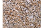 The image on the left is immunohistochemistry of paraffin-embedded Human prostate cancer tissue using CSB-PA119051(AATK Antibody) at dilution 1/45, on the right is treated with synthetic peptide. (Original magnification: 
