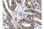 The image on the left is immunohistochemistry of paraffin-embedded Human colon cancer tissue using CSB-PA119092(CLDN7 Antibody) at dilution 1/50, on the right is treated with synthetic peptide. (Original magnification: 