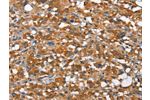 The image on the left is immunohistochemistry of paraffin-embedded Human thyroid cancer tissue using CSB-PA119240(ARMCX2 Antibody) at dilution 1/30, on the right is treated with fusion protein. (Original magnification: 