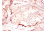 Immunohistochemistry of paraffin-embeded human colorectal carcinoma using CSB-PA11947A0Rb at dilution of 1:50