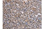 The image is immunohistochemistry of paraffin-embedded Human thyroid cancer tissue using CSB-PA119536(GADD45A Antibody) at dilution 1/30. (Original magnification: 200)