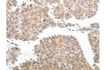 The image on the left is immunohistochemistry of paraffin-embedded Human liver cancer tissue using CSB-PA119696(ABL2 Antibody) at dilution 1/25, on the right is treated with synthetic peptide. (Original magnification: 