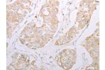 The image on the left is immunohistochemistry of paraffin-embedded Human breast cancer tissue using CSB-PA119733(ADAM28 Antibody) at dilution 1/30, on the right is treated with synthetic peptide. (Original magnification: 