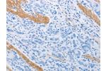 The image on the left is immunohistochemistry of paraffin-embedded Human gastic cancer tissue using CSB-PA120361(ADRB3 Antibody) at dilution 1/20, on the right is treated with synthetic peptide. (Original magnification: 