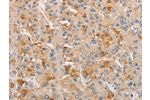 The image on the left is immunohistochemistry of paraffin-embedded Human liver cancer tissue using CSB-PA120422(ARSF Antibody) at dilution 1/20, on the right is treated with fusion protein. (Original magnification: 