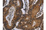 The image on the left is immunohistochemistry of paraffin-embedded Human colon cancer tissue using CSB-PA120525(FGF18 Antibody) at dilution 1/20, on the right is treated with fusion protein. (Original magnification: 