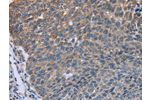 The image on the left is immunohistochemistry of paraffin-embedded Human lung cancer tissue using CSB-PA120564(GNAI3 Antibody) at dilution 1/30, on the right is treated with fusion protein. (Original magnification: 