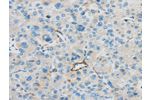 The image on the left is immunohistochemistry of paraffin-embedded Human liver cancer tissue using CSB-PA120615(CD63 Antibody) at dilution 1/35, on the right is treated with synthetic peptide. (Original magnification: 