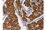 The image on the left is immunohistochemistry of paraffin-embedded Human breast cancer tissue using CSB-PA121899(CRABP2 Antibody) at dilution 1/40, on the right is treated with fusion protein. (Original magnification: 