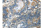 The image on the left is immunohistochemistry of paraffin-embedded Human colon cancer tissue using CSB-PA122487(ADCK4 Antibody) at dilution 1/25, on the right is treated with fusion protein. (Original magnification: 
