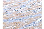 The image on the left is immunohistochemistry of paraffin-embedded Human colon cancer tissue using CSB-PA122612(EPHA1 Antibody) at dilution 1/25, on the right is treated with synthetic peptide. (Original magnification: 