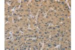 The image on the left is immunohistochemistry of paraffin-embedded Human liver cancer tissue using CSB-PA122670(CYFIP2 Antibody) at dilution 1/25, on the right is treated with fusion protein. (Original magnification: 