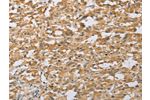The image on the left is immunohistochemistry of paraffin-embedded Human thyroid cancer tissue using CSB-PA123263(ARHGEF1 Antibody) at dilution 1/50, on the right is treated with fusion protein. (Original magnification: 