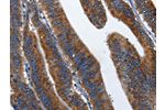 The image on the left is immunohistochemistry of paraffin-embedded Human colon cancer tissue using CSB-PA123791(CD27 Antibody) at dilution 1/60, on the right is treated with fusion protein. (Original magnification: 