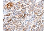 The image on the left is immunohistochemistry of paraffin-embedded Human breast cancer tissue using CSB-PA123895(FOXD2 Antibody) at dilution 1/10, on the right is treated with synthetic peptide. (Original magnification: 