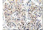 The image on the left is immunohistochemistry of paraffin-embedded Human liver cancer tissue using CSB-PA123968(APP Antibody) at dilution 1/100, on the right is treated with synthetic peptide. (Original magnification: 