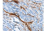 The image on the left is immunohistochemistry of paraffin-embedded Human prostate cancer tissue using CSB-PA125050(ACTA2 Antibody) at dilution 1/30, on the right is treated with synthetic peptide. (Original magnification: 